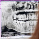 Ρευματοειδής-αρθρίτιδα-και-δόντια:-Τι-πρέπει-να-γνωρίζετε
